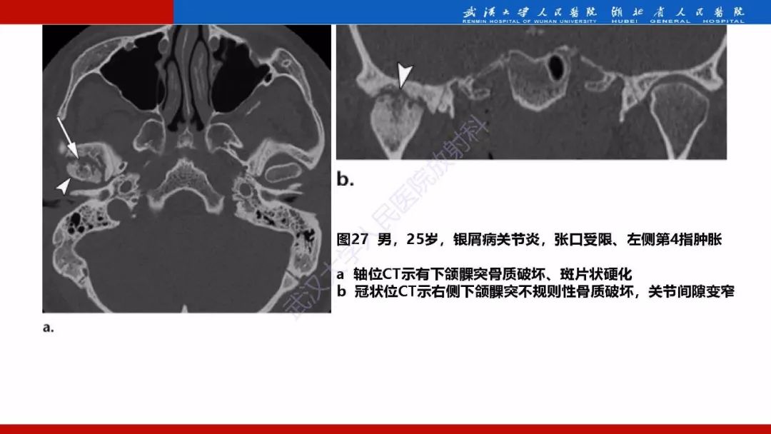 【PPT】系统性疾病累及颅面骨的影像表现