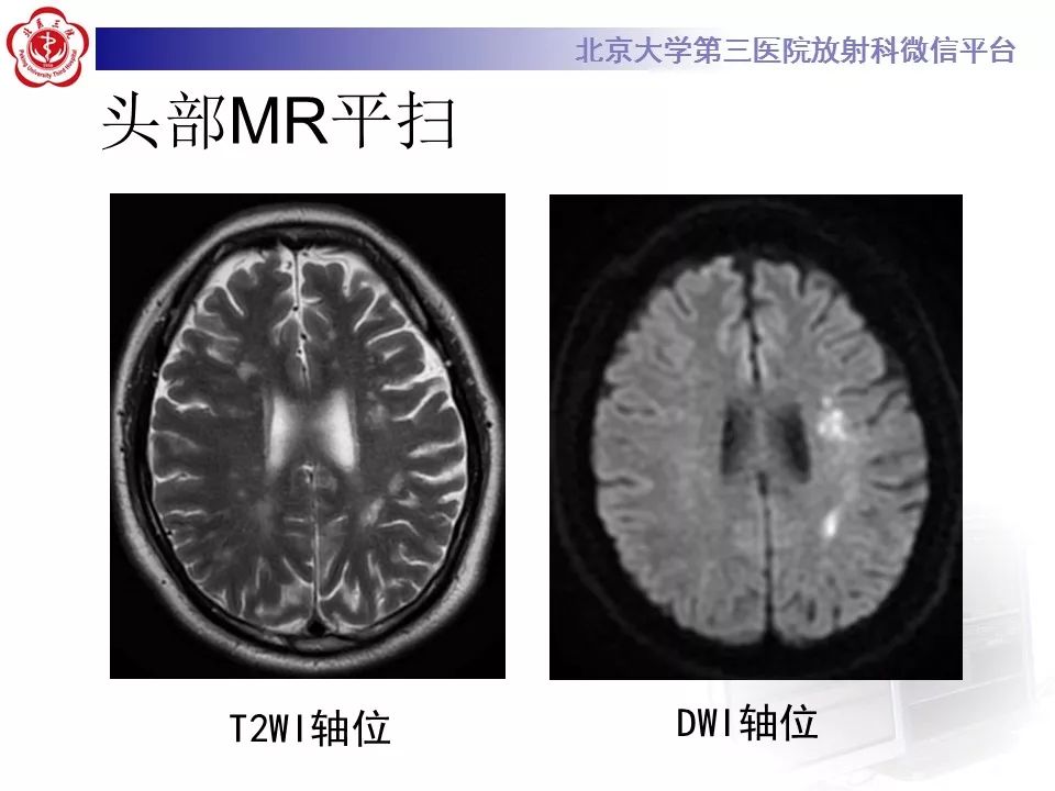【病例】烟雾病1例CT及MR影像表现