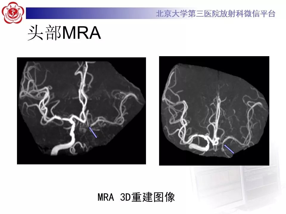 【病例】烟雾病1例CT及MR影像表现