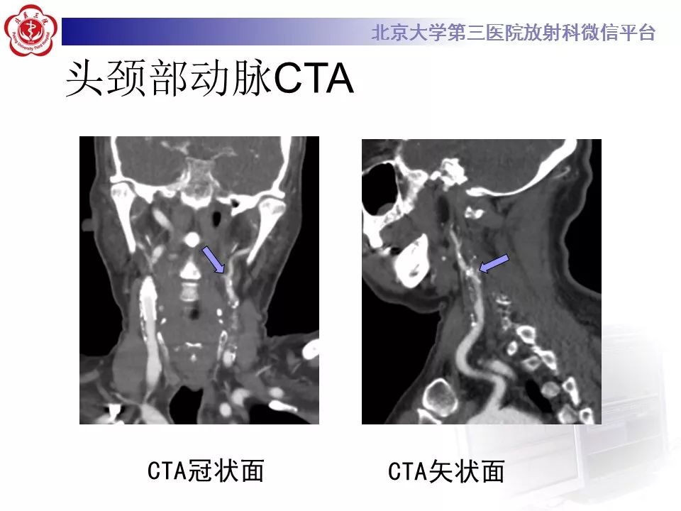 【病例】烟雾病1例CT及MR影像表现