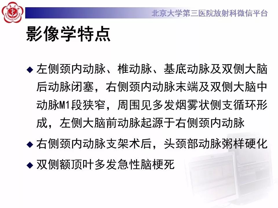 【病例】烟雾病1例CT及MR影像表现