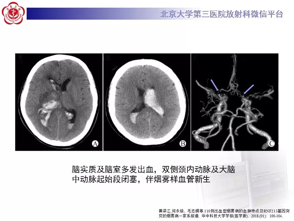 【病例】烟雾病1例CT及MR影像表现