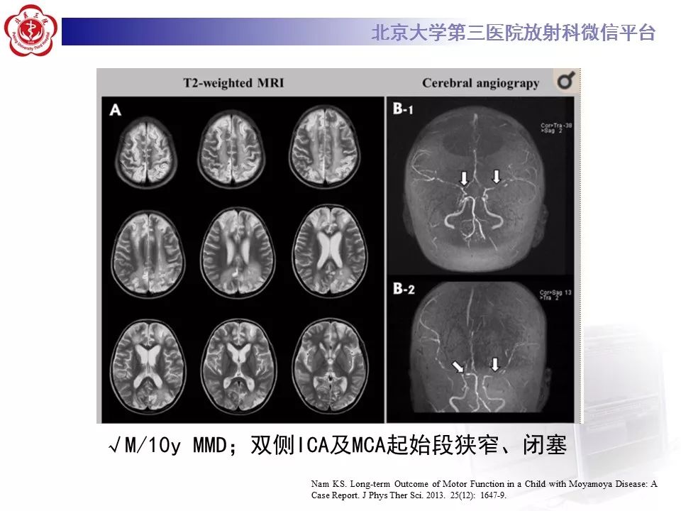 【病例】烟雾病1例CT及MR影像表现