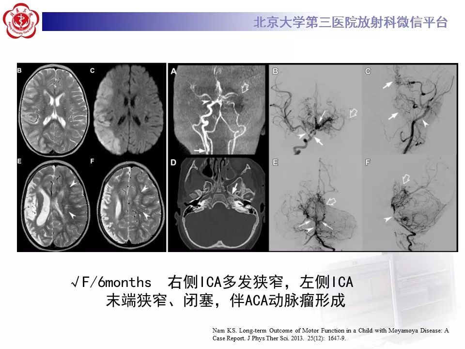 【病例】烟雾病1例CT及MR影像表现