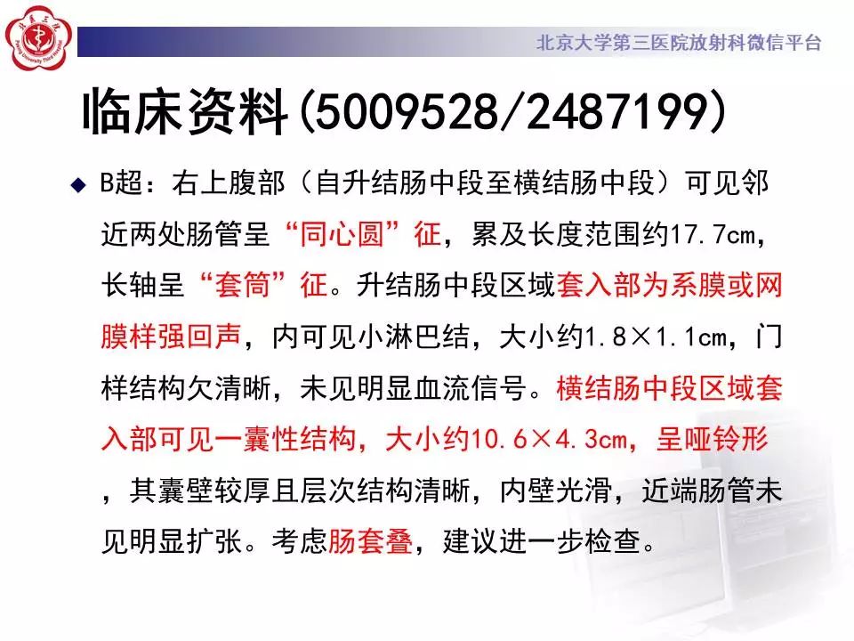 【病例】阑尾套叠1例CT影像表现