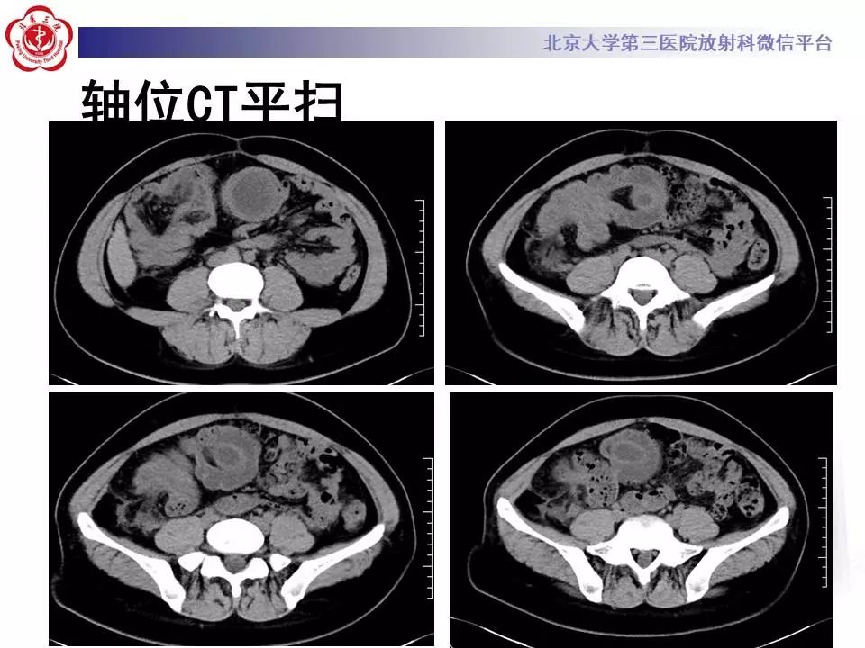 【病例】阑尾套叠1例CT影像表现