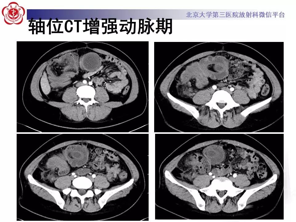 【病例】阑尾套叠1例CT影像表现