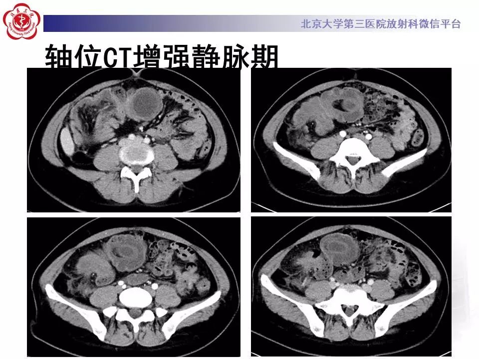 【病例】阑尾套叠1例CT影像表现