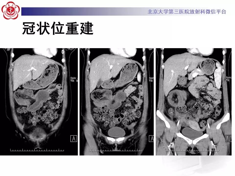 【病例】阑尾套叠1例CT影像表现