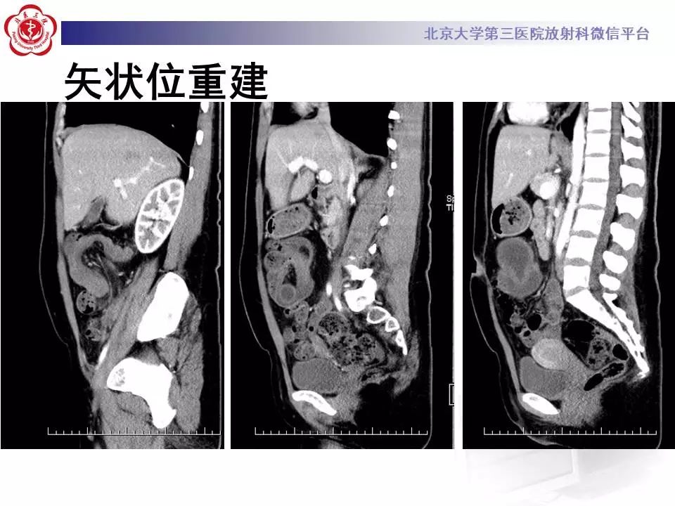【病例】阑尾套叠1例CT影像表现