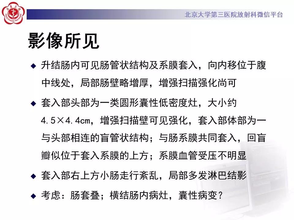 【病例】阑尾套叠1例CT影像表现