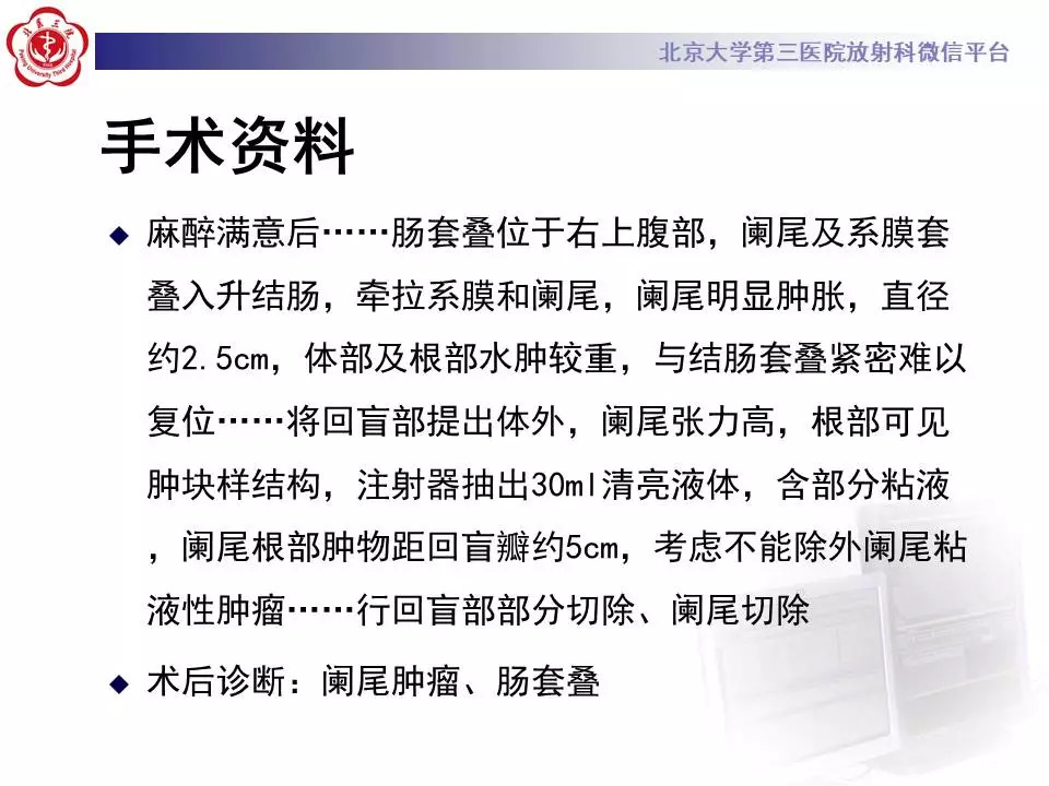 【病例】阑尾套叠1例CT影像表现