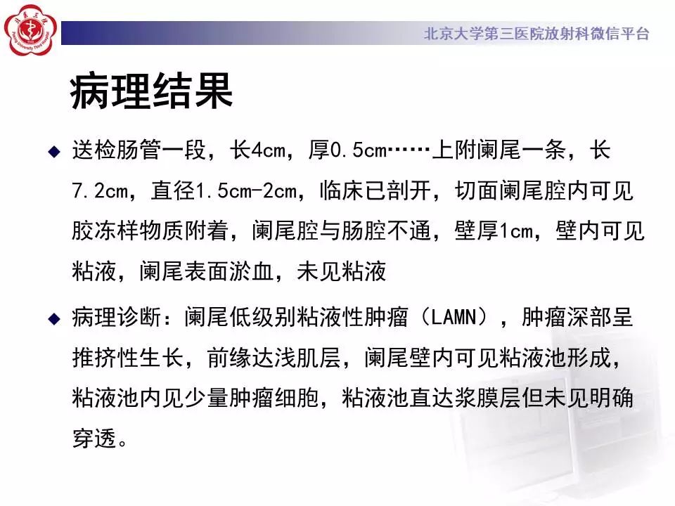 【病例】阑尾套叠1例CT影像表现