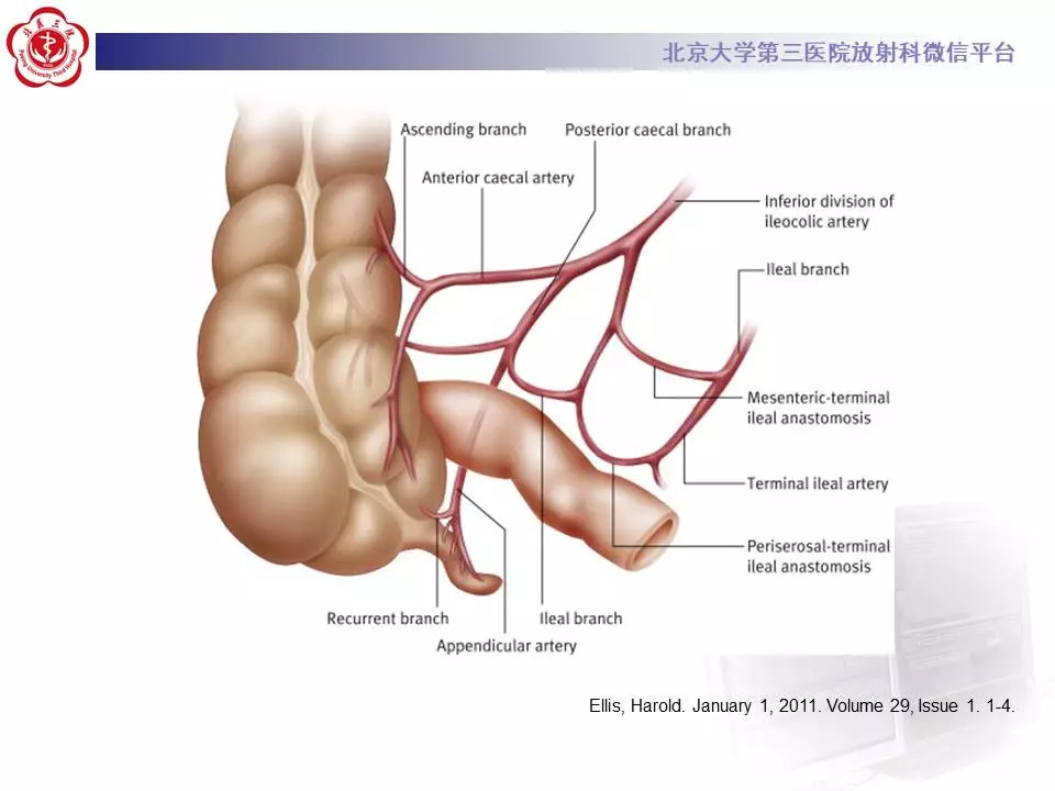 【病例】阑尾套叠1例CT影像表现