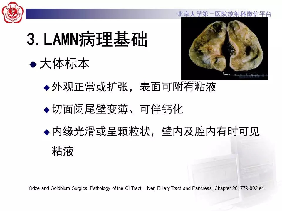 【病例】阑尾套叠1例CT影像表现