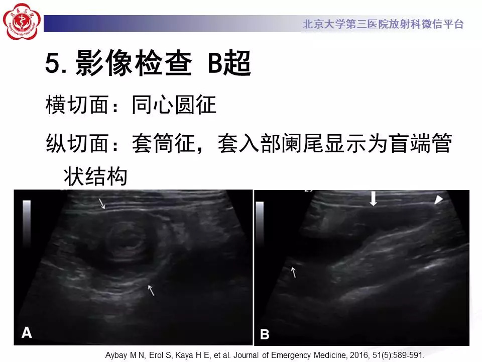 【病例】阑尾套叠1例CT影像表现