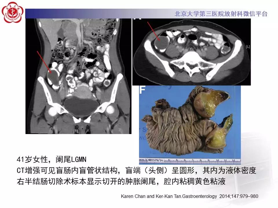 【病例】阑尾套叠1例CT影像表现