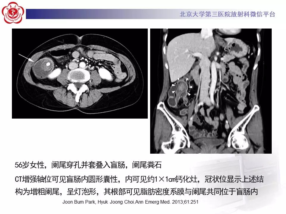 【病例】阑尾套叠1例CT影像表现
