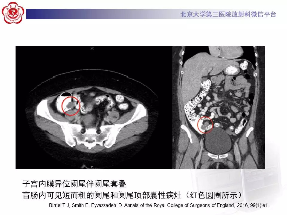 【病例】阑尾套叠1例CT影像表现