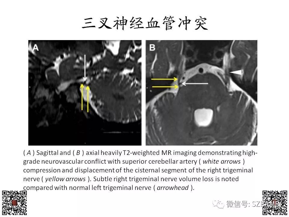 【PPT】神经血管压迫综合征的影像学表现