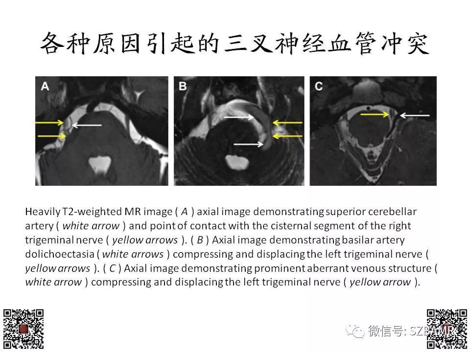 【PPT】神经血管压迫综合征的影像学表现