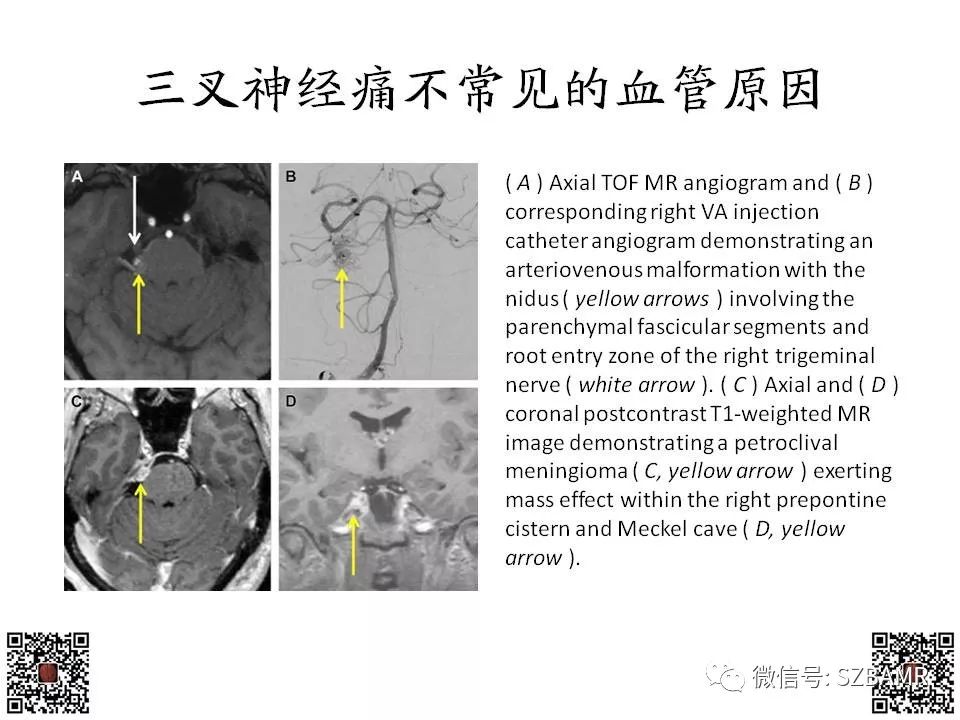 【PPT】神经血管压迫综合征的影像学表现