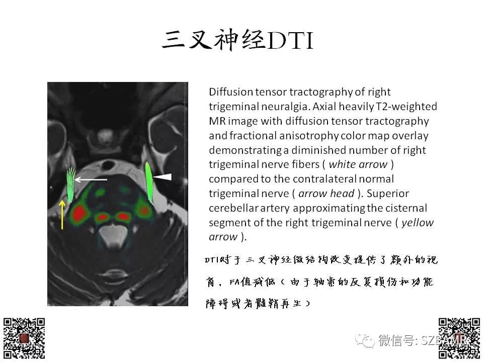 【PPT】神经血管压迫综合征的影像学表现