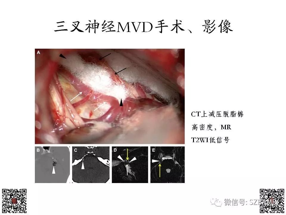 【PPT】神经血管压迫综合征的影像学表现