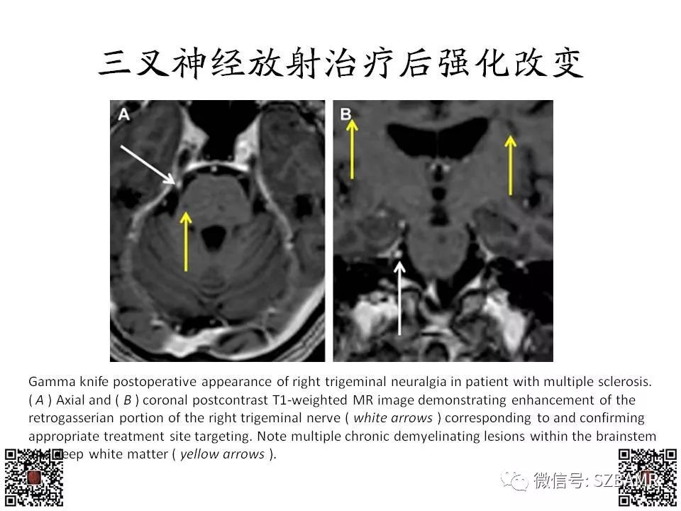 【PPT】神经血管压迫综合征的影像学表现