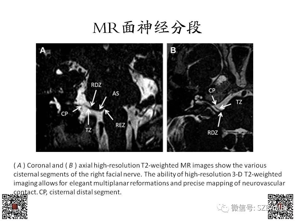 【PPT】神经血管压迫综合征的影像学表现