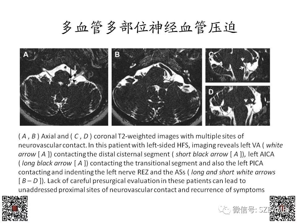 【PPT】神经血管压迫综合征的影像学表现