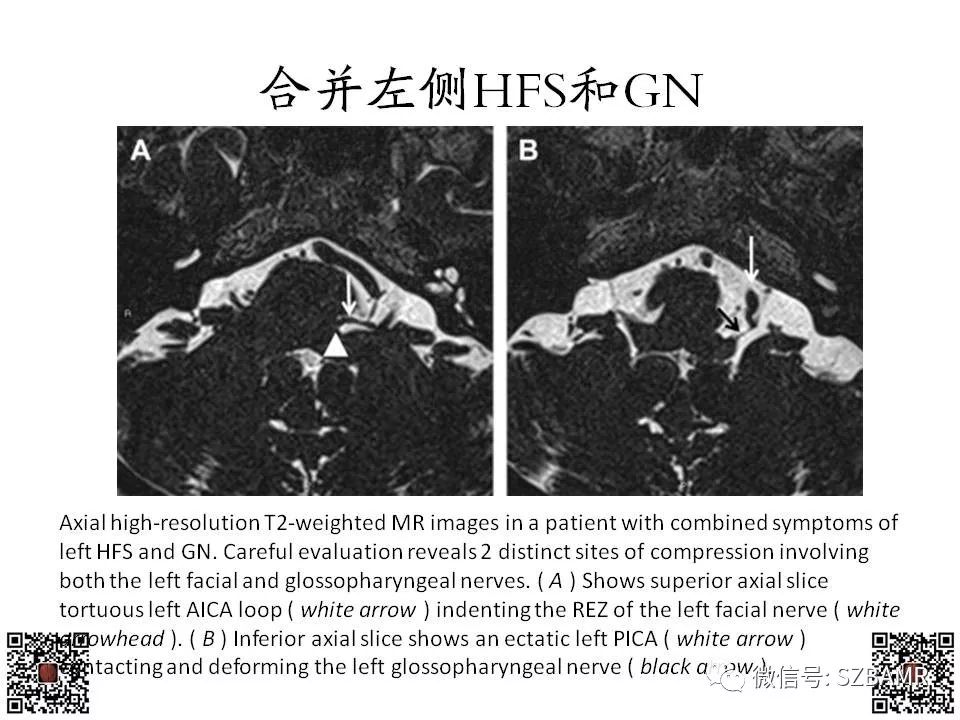 【PPT】神经血管压迫综合征的影像学表现