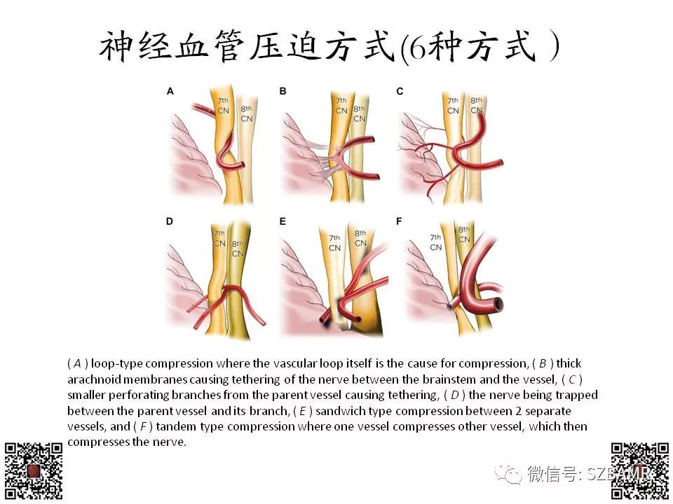 【PPT】神经血管压迫综合征的影像学表现