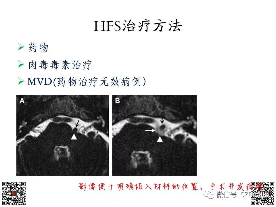 【PPT】神经血管压迫综合征的影像学表现