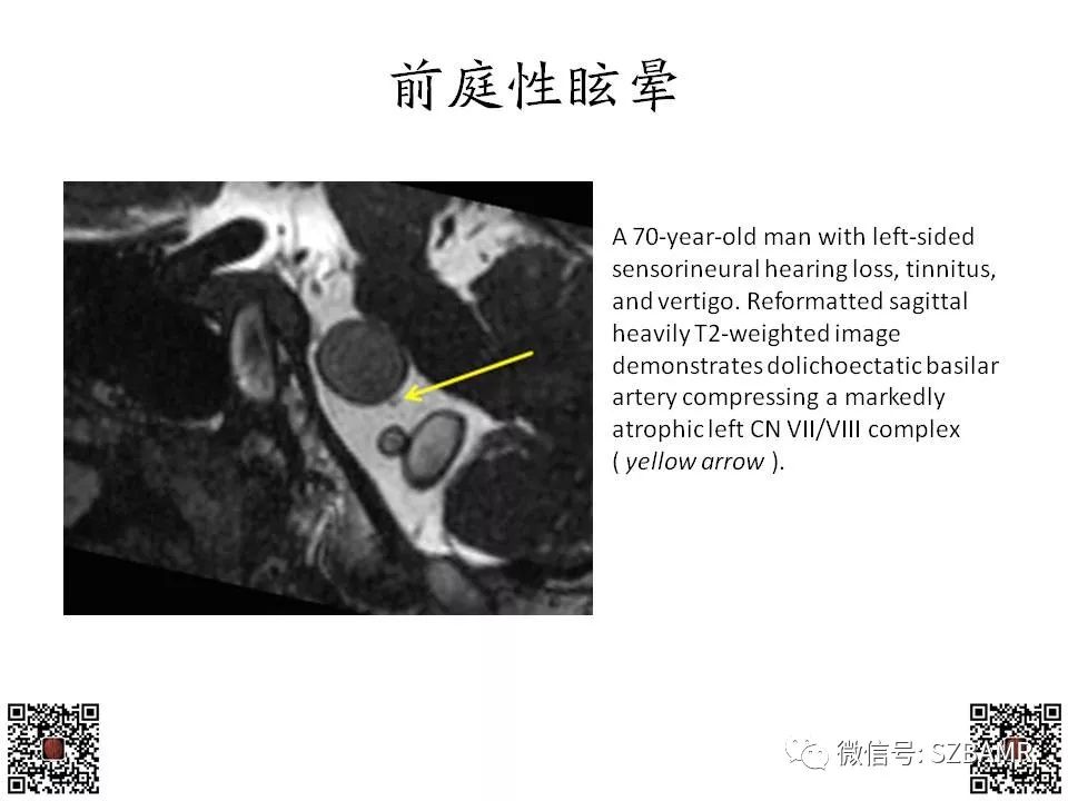 【PPT】神经血管压迫综合征的影像学表现