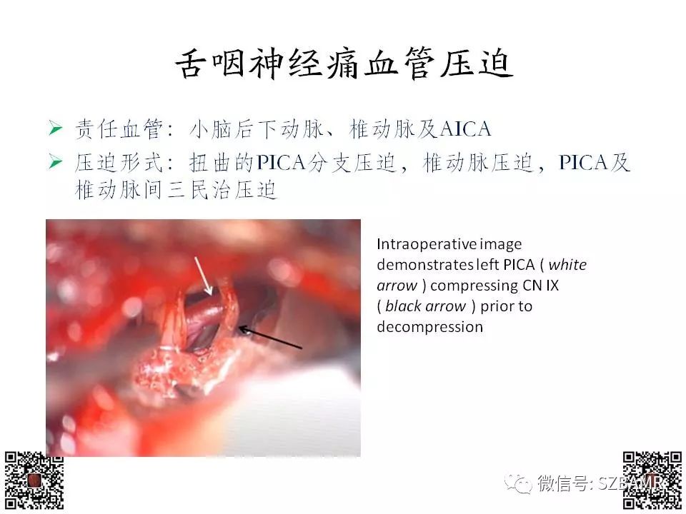 【PPT】神经血管压迫综合征的影像学表现