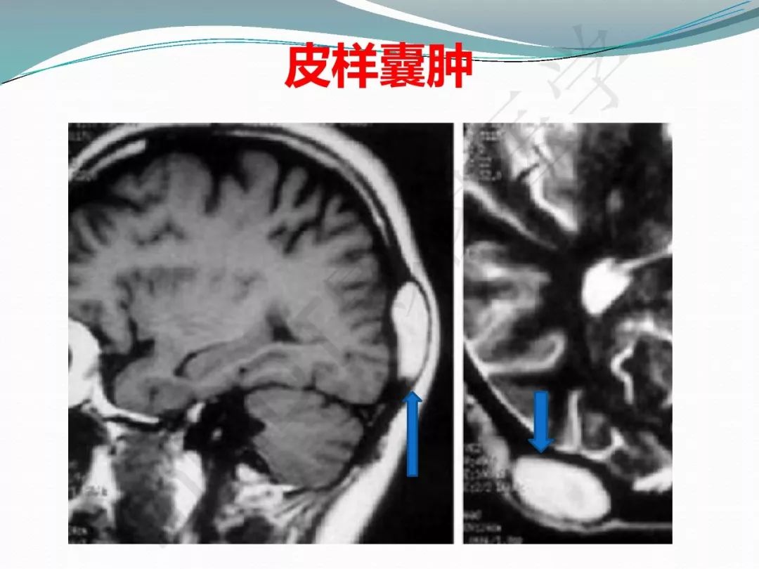 【PPT】骨嗜酸性肉芽肿（LCH）影像诊断及鉴别诊断