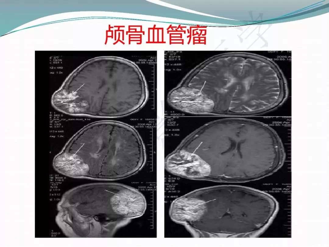【PPT】骨嗜酸性肉芽肿（LCH）影像诊断及鉴别诊断