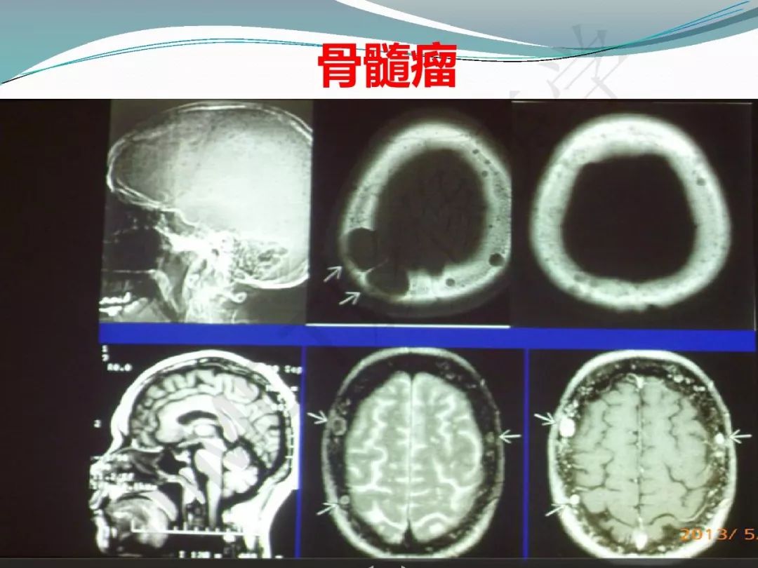 【PPT】骨嗜酸性肉芽肿（LCH）影像诊断及鉴别诊断