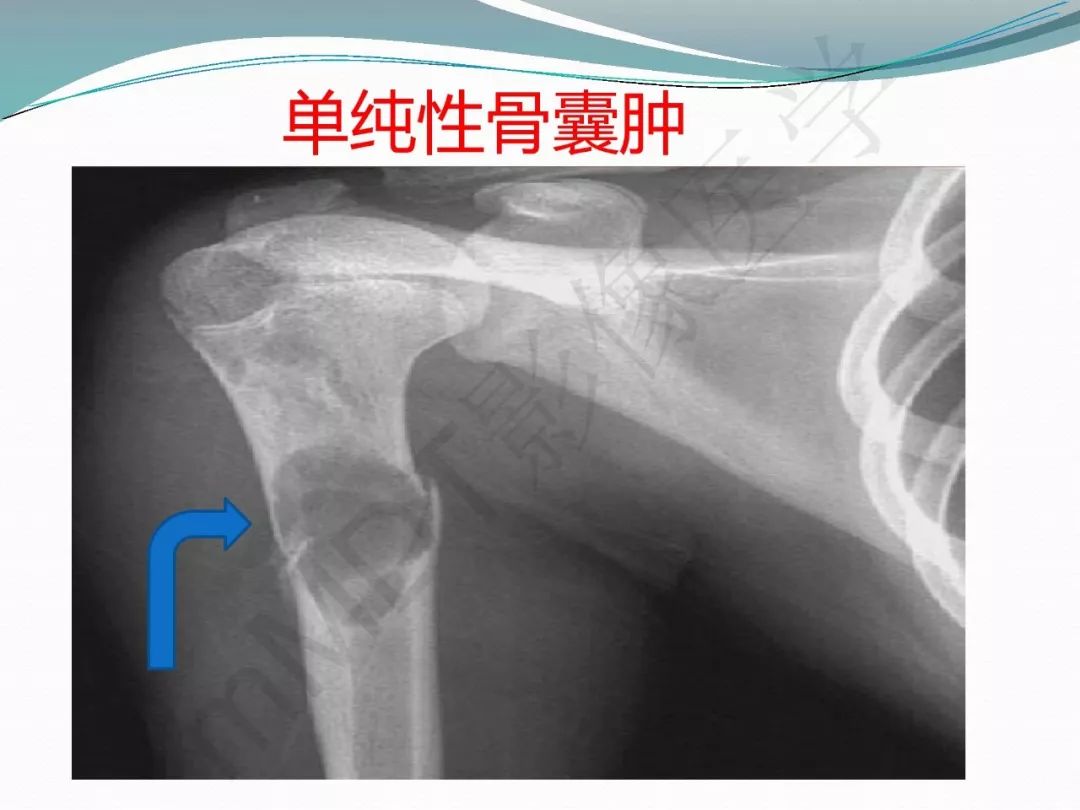 【PPT】骨嗜酸性肉芽肿（LCH）影像诊断及鉴别诊断