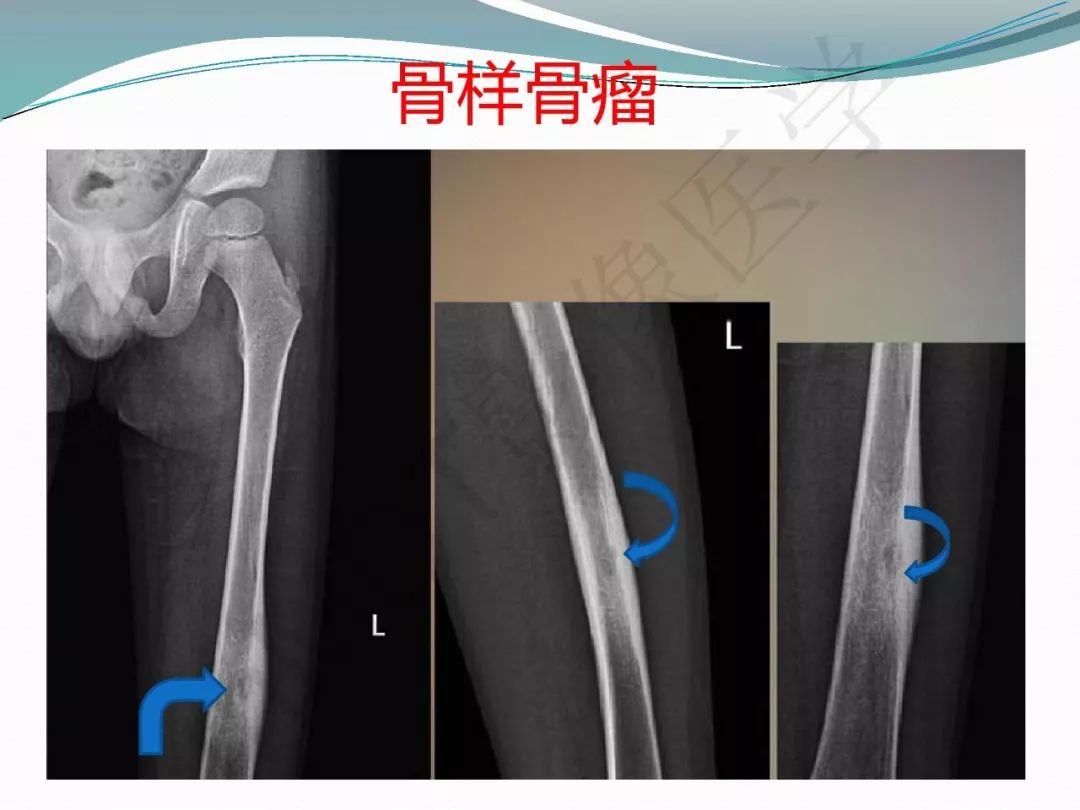 【PPT】骨嗜酸性肉芽肿（LCH）影像诊断及鉴别诊断