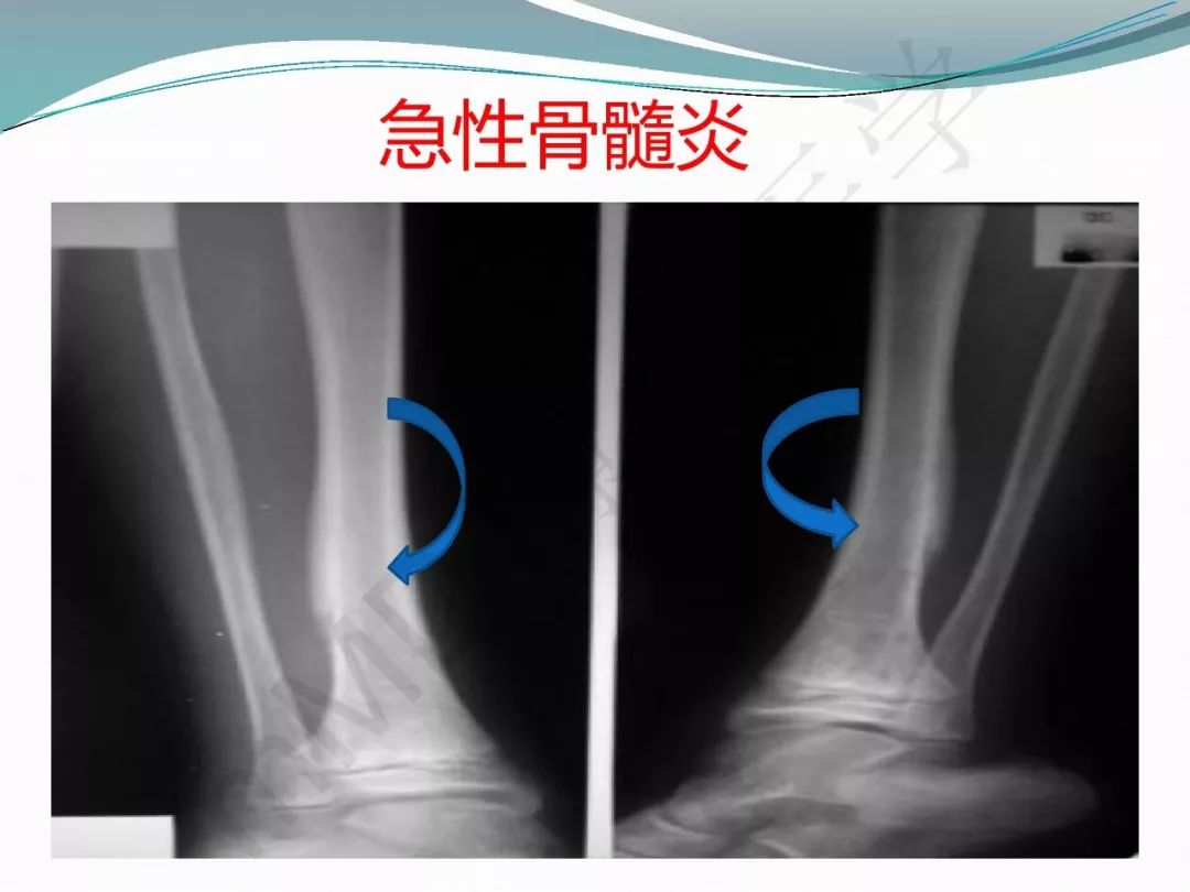 【PPT】骨嗜酸性肉芽肿（LCH）影像诊断及鉴别诊断
