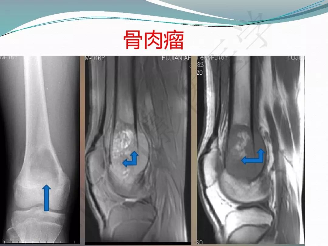 【PPT】骨嗜酸性肉芽肿（LCH）影像诊断及鉴别诊断