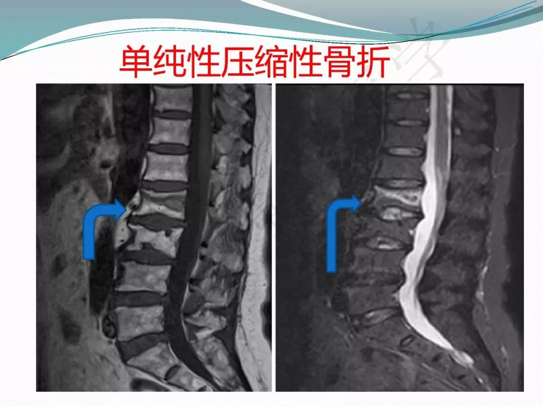 【PPT】骨嗜酸性肉芽肿（LCH）影像诊断及鉴别诊断