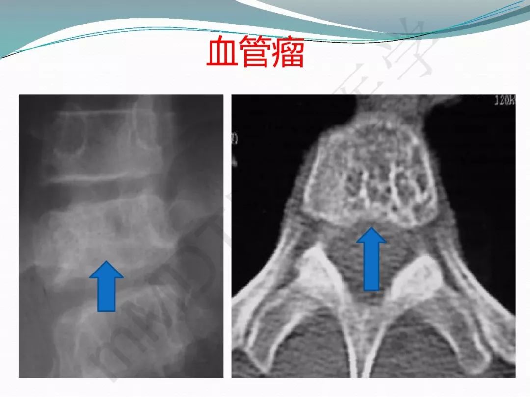 【PPT】骨嗜酸性肉芽肿（LCH）影像诊断及鉴别诊断