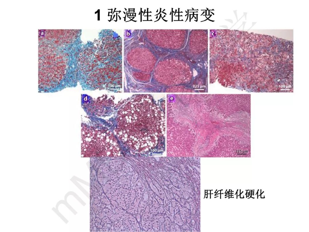 【PPT】纤维组织在肝脏炎性病变MR诊断中的价值