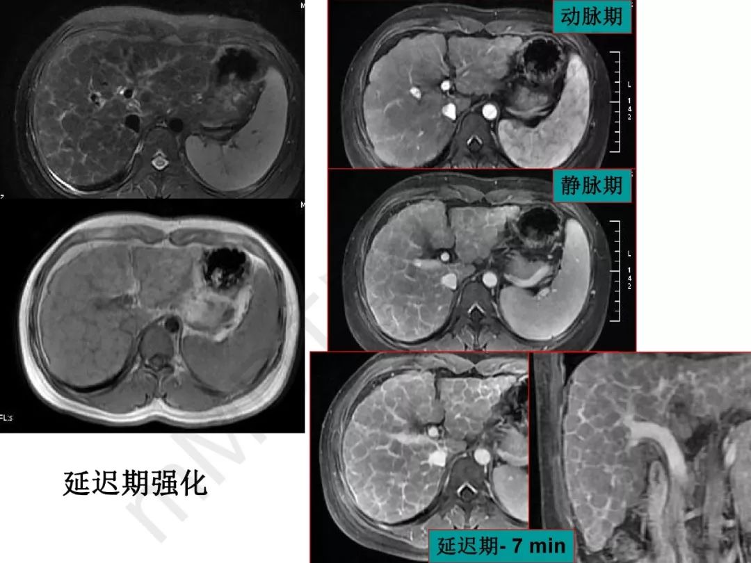 【PPT】纤维组织在肝脏炎性病变MR诊断中的价值