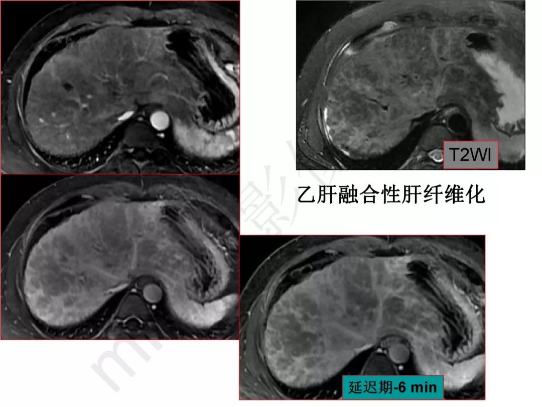 【PPT】纤维组织在肝脏炎性病变MR诊断中的价值