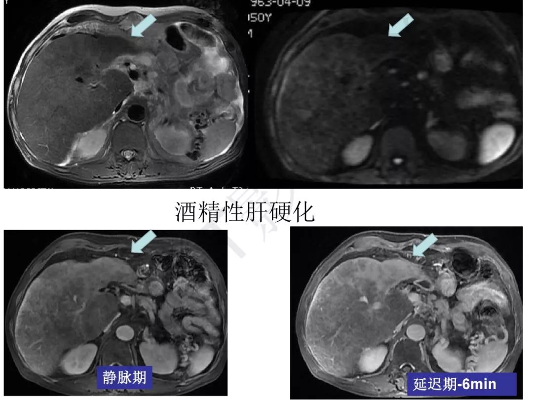 【PPT】纤维组织在肝脏炎性病变MR诊断中的价值