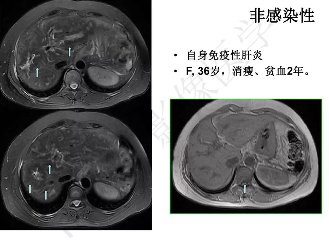 【PPT】纤维组织在肝脏炎性病变MR诊断中的价值